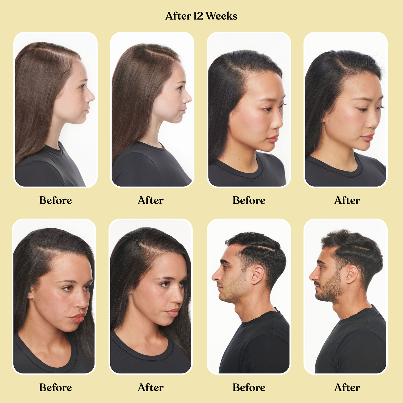 before and after of several humans showing hair growth  