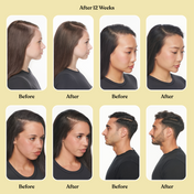 before and after of several humans showing hair growth  